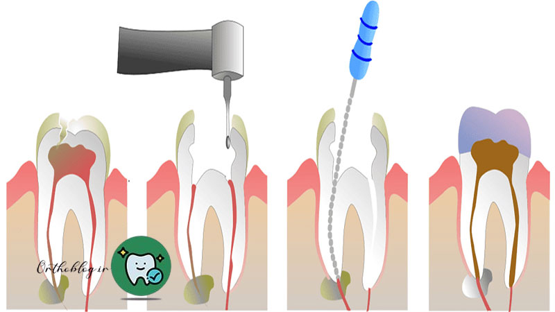 مراحل انجام عصب‌کشی دندان