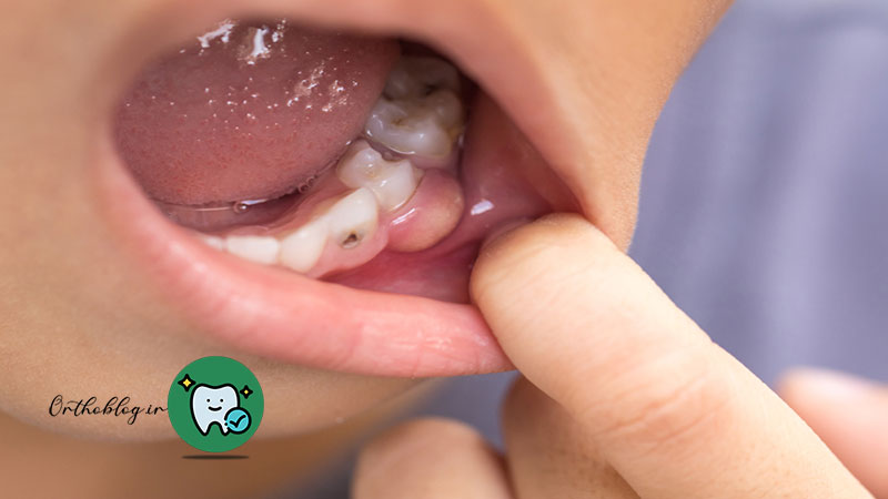 علت ایجاد کیست دندان