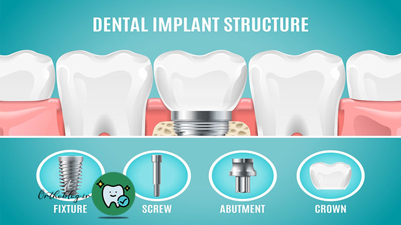 ایمپلنت دندان چیست؟