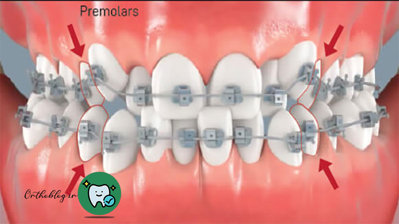 استفاده از فضاهای موجود با ارتودنسی بدون کشیدن دندان