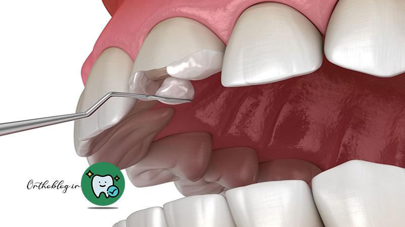 مرتب کردن دندان بدون ارتودنسی با کامپوزیت (Composite Resin)