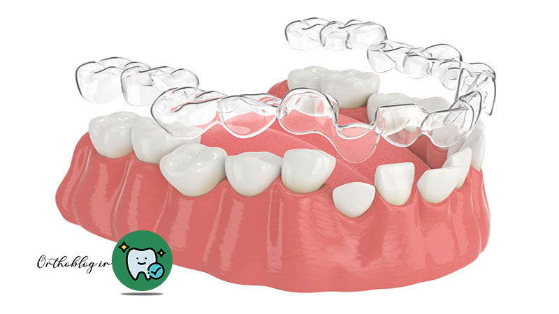 عوامل موثر بر کاهش زمان ارتودنسی با الاینرهای شفاف